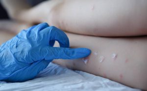 آلرژی به لاتکس: علائم، علل و روش‌های درمان جامع 4