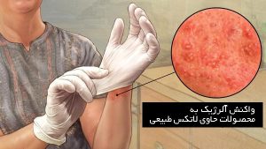 آلرژی به لاتکس، علائم و درمان حساسیت به دستکش لاتکس 