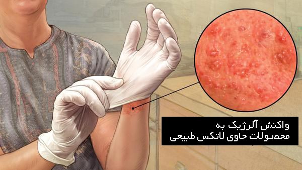 آلرژی به لاتکس: علائم، علل و روش‌های درمان جامع